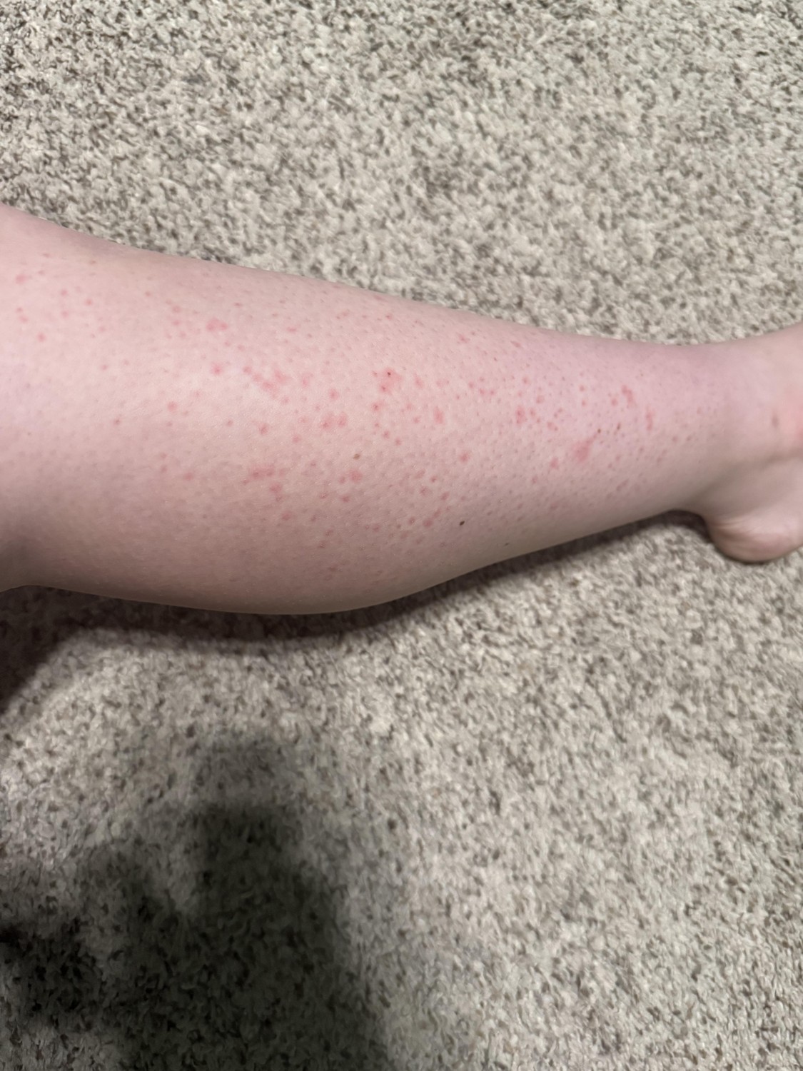 Piernas con irritación y granitos post-rasurado